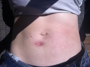 scar from c-section complications