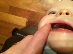 Bruised gums from teething