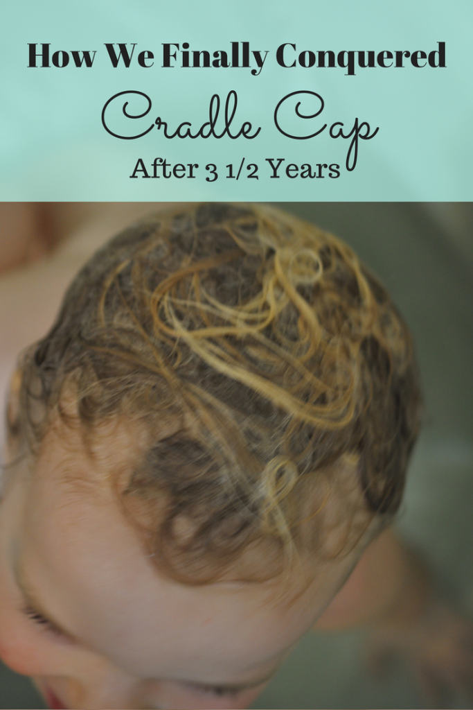 Cradle Cap Conquered What Finally Worked After 3 Years The Big