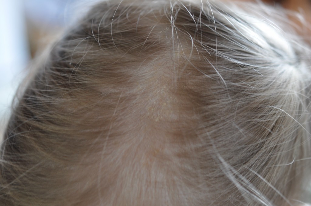 cradle cap on three year old