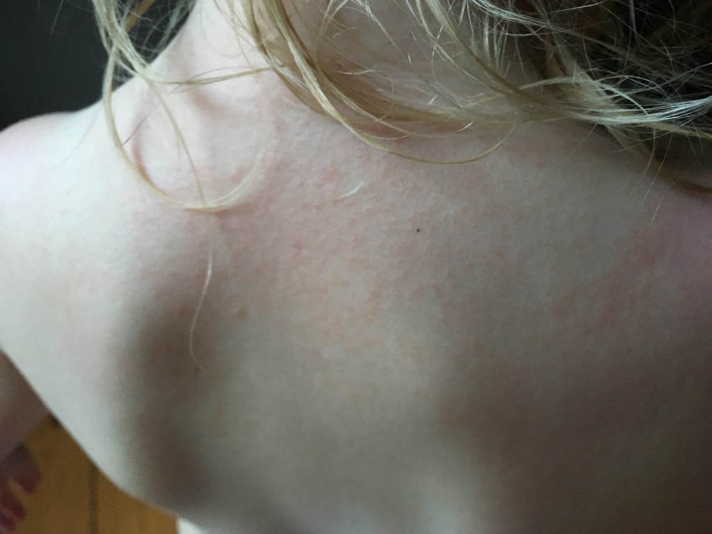 rash from sunscreen